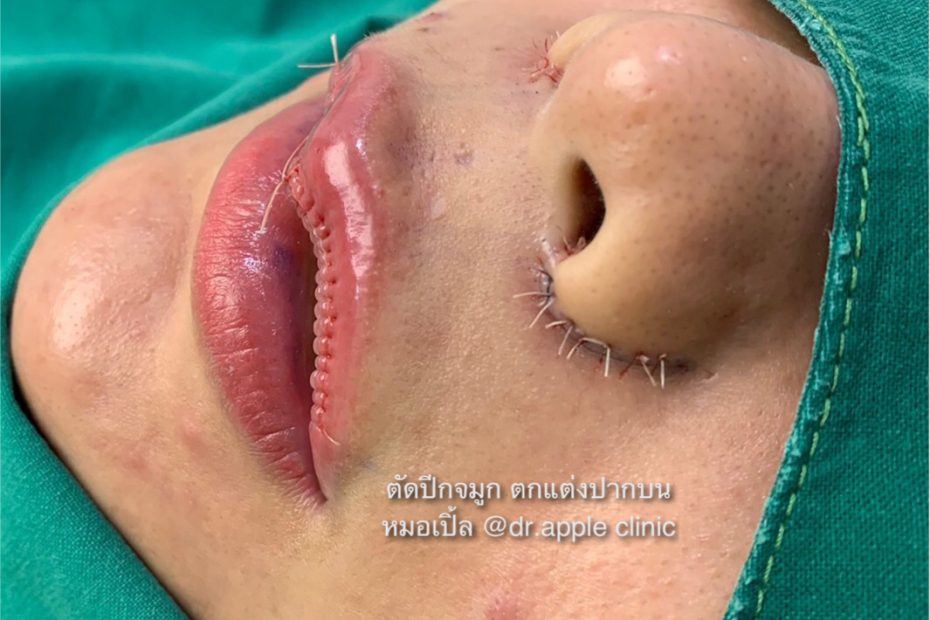 ปากกระจับ แก้ไขริมฝีปาก และการตัดปีกจมูก, คลินิคศัลยกรรมความงาม โดย นายแพทย์ พลศักดิ์ วรไกร (หมอเปิ้ล)