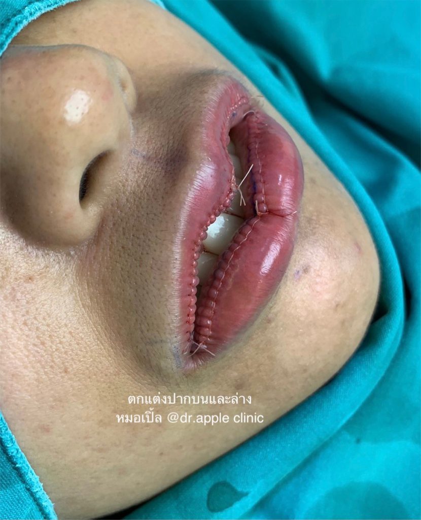❤️ปากล่างรูปหัวใจ หรือ ทรงพิมรี่พาย💋, คลินิคศัลยกรรมความงาม โดย นายแพทย์ พลศักดิ์ วรไกร (หมอเปิ้ล)