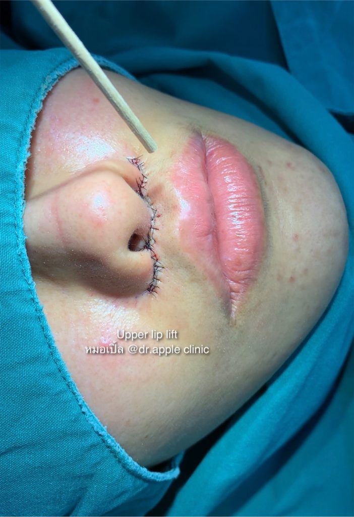Upper lip Lift2