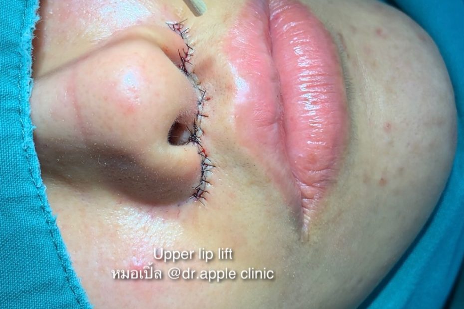 Upper Lip Lift Surgery 💋, คลินิคศัลยกรรมความงาม โดย นายแพทย์ พลศักดิ์ วรไกร (หมอเปิ้ล)