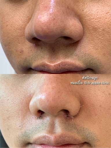 ทำปากและจมูกสำหรับผู้ชาย, คลินิคศัลยกรรมความงาม โดย นายแพทย์ พลศักดิ์ วรไกร (หมอเปิ้ล)