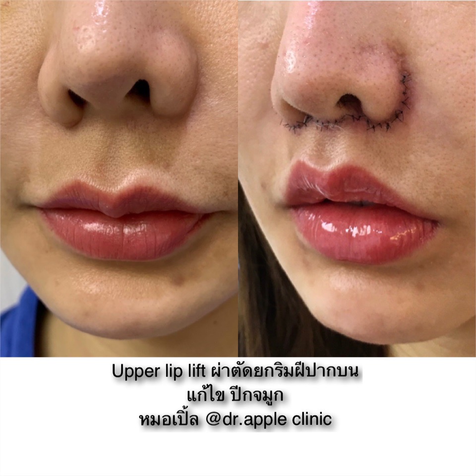 การดูแลตัวเองหลังการผ่าตัด Upper Lip Lift, คลินิคศัลยกรรมความงาม โดย นายแพทย์ พลศักดิ์ วรไกร (หมอเปิ้ล)