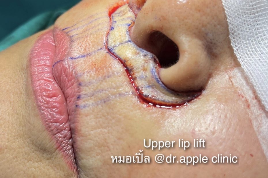 Upper Lip Lift ข้อเสีย ข้อควรระวัง ข้อควรรู้, คลินิคศัลยกรรมความงาม โดย นายแพทย์ พลศักดิ์ วรไกร (หมอเปิ้ล)
