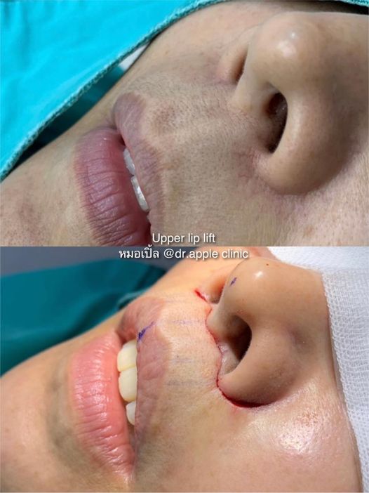 Upper Lip Lift กับคำถามยอดฮิต👄, คลินิคศัลยกรรมความงาม โดย นายแพทย์ พลศักดิ์ วรไกร (หมอเปิ้ล)