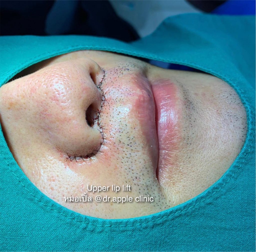upper lip 11