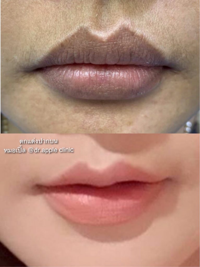ปากกระจับมีกี่ทรง? ทำทรงไหนดีให้สวยปังเหมาะกับรูปหน้า, คลินิคศัลยกรรมความงาม โดย นายแพทย์ พลศักดิ์ วรไกร (หมอเปิ้ล)