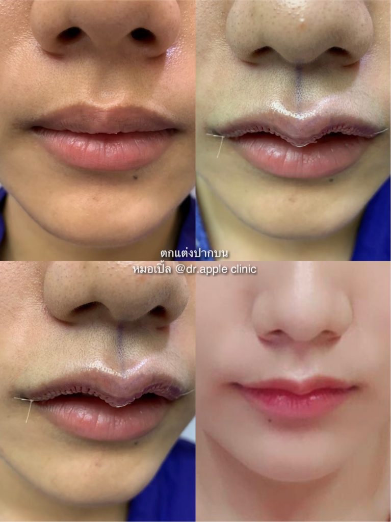 ปากกระจับมีกี่ทรง? ทำทรงไหนดีให้สวยปังเหมาะกับรูปหน้า, คลินิคศัลยกรรมความงาม โดย นายแพทย์ พลศักดิ์ วรไกร (หมอเปิ้ล)