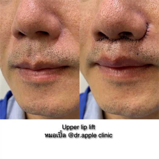 Bullhorn VS Upper Lip Lift, คลินิคศัลยกรรมความงาม โดย นายแพทย์ พลศักดิ์ วรไกร (หมอเปิ้ล)