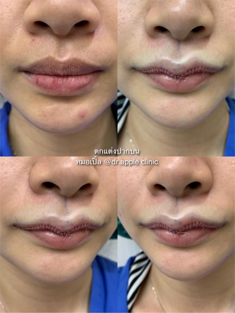 ติ่งกระจับ และยกมุมปาก Dr. Apple Technique, คลินิคศัลยกรรมความงาม โดย นายแพทย์ พลศักดิ์ วรไกร (หมอเปิ้ล)