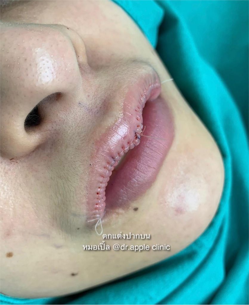 ติ่งกระจับ และยกมุมปาก Dr. Apple Technique, คลินิคศัลยกรรมความงาม โดย นายแพทย์ พลศักดิ์ วรไกร (หมอเปิ้ล)