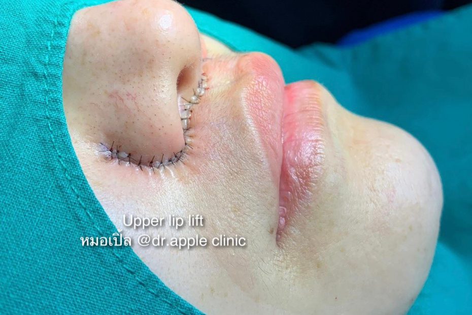 Upper Lip Lift ดูแลอย่างไร, คลินิคศัลยกรรมความงาม โดย นายแพทย์ พลศักดิ์ วรไกร (หมอเปิ้ล)