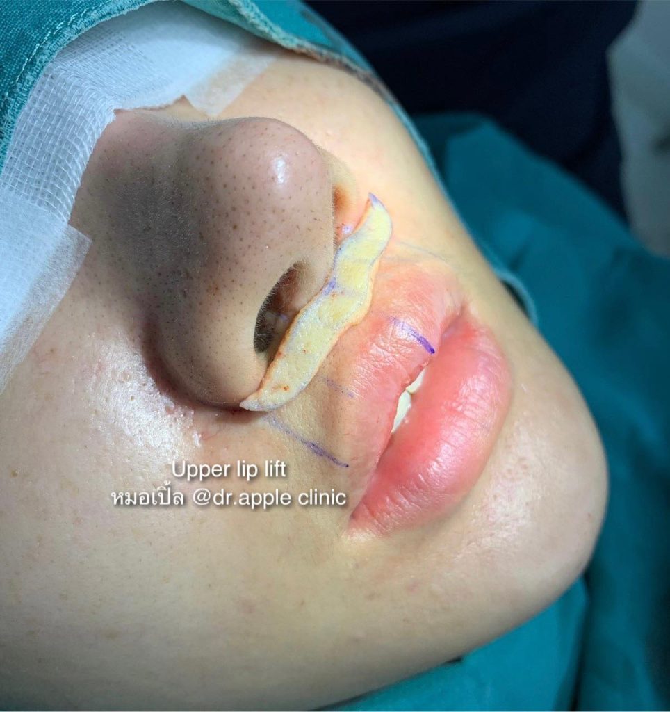 ผ่าตัด ยกริมฝีปากบน lip lift surgery, คลินิคศัลยกรรมความงาม โดย นายแพทย์ พลศักดิ์ วรไกร (หมอเปิ้ล)