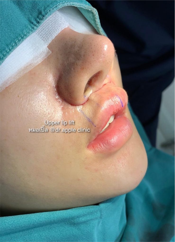 ผ่าตัด ยกริมฝีปากบน lip lift surgery, คลินิคศัลยกรรมความงาม โดย นายแพทย์ พลศักดิ์ วรไกร (หมอเปิ้ล)
