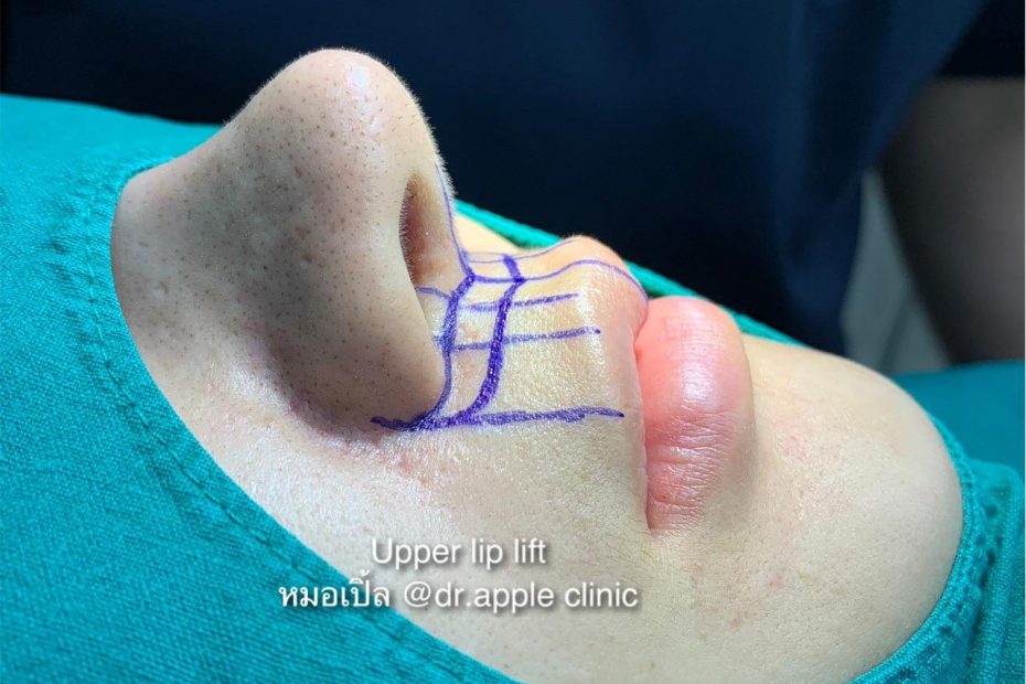 Upper Lip Lift or ยกริมฝีปากบน, คลินิคศัลยกรรมความงาม โดย นายแพทย์ พลศักดิ์ วรไกร (หมอเปิ้ล)