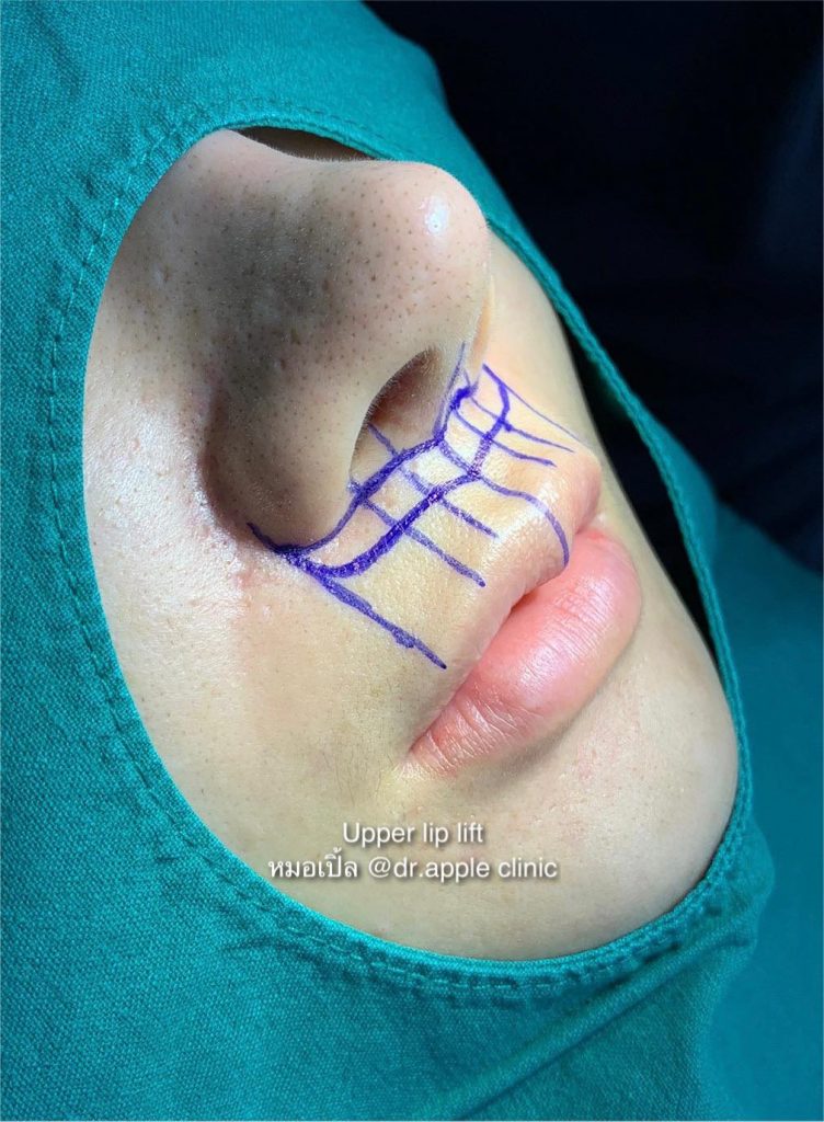 Upper Lip Lift or ยกริมฝีปากบน, คลินิคศัลยกรรมความงาม โดย นายแพทย์ พลศักดิ์ วรไกร (หมอเปิ้ล)